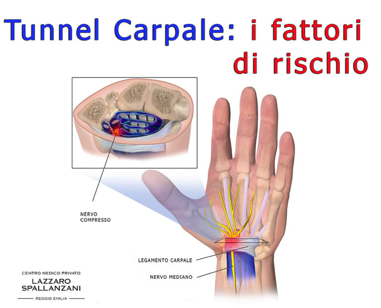 tunnel carpale | Centro Medico Privato Lazzaro Spallanzani